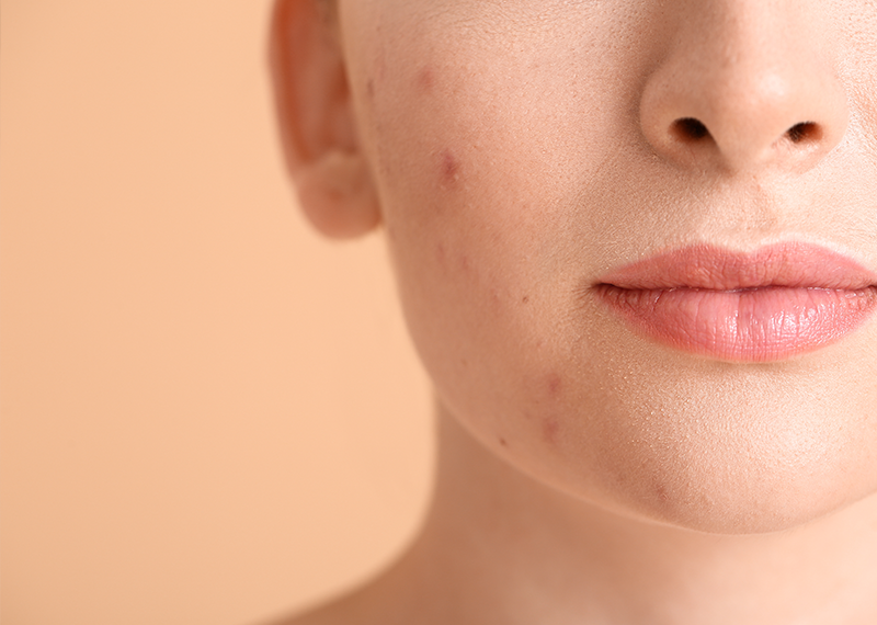 Clearer Skin in Houston: An Esthetician's Guide to Treating Adult Acne Safely