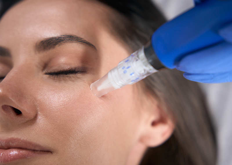 Clear Lift Microneedling